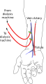 Radiocephalic fistula