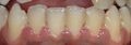 Ulcerative necrotizing gingivitis