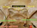 Anterior clinoid process