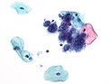 Herpes simplex virus pap test