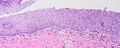Koilocyte