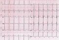 EKG depiction of left ventricular hypertrophy