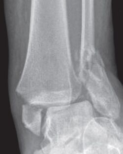 X-ray of bimalleolar fracture