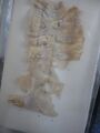 Amoebic Ulcer Intestine
