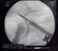 Laparoscopy Roentgen