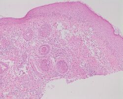 Micrograph of rosacea