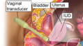 Mirena in optimal place - schematic