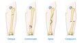 Types of fracture