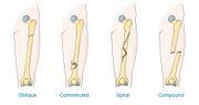 Types of fracture