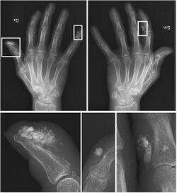 Calcinosis cutis