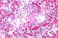 Hyaline membranes under very high magnification