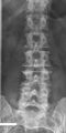 Lumbarization of sacral vertebra 1, seen as 6 vertebrae that do not connect to ribs.