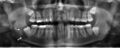 Jaw cyst with arrows