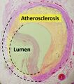 Coronary occlusion
