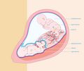 Twin-to-twin transfusion syndrome