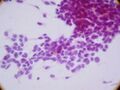 Small-blue-round-cell_tumor