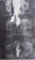 Arachnoiditis
