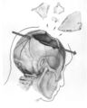X-ray showing the parietal bone