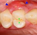 Cracked tooth lateral periodontal abscess