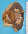 Renal oncocytoma