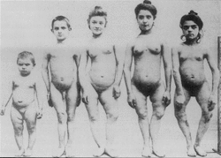 Rickets