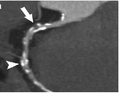 CT angiography of the heart
