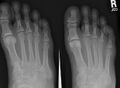 X-ray of a foot