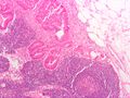 CRC metastasis to node