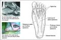Plantar Fascia Design
