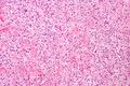 Solitary fibrous tumour