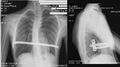 X-ray image showing the Nuss procedure