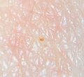 Trombiculid mite larvae attached to human skin