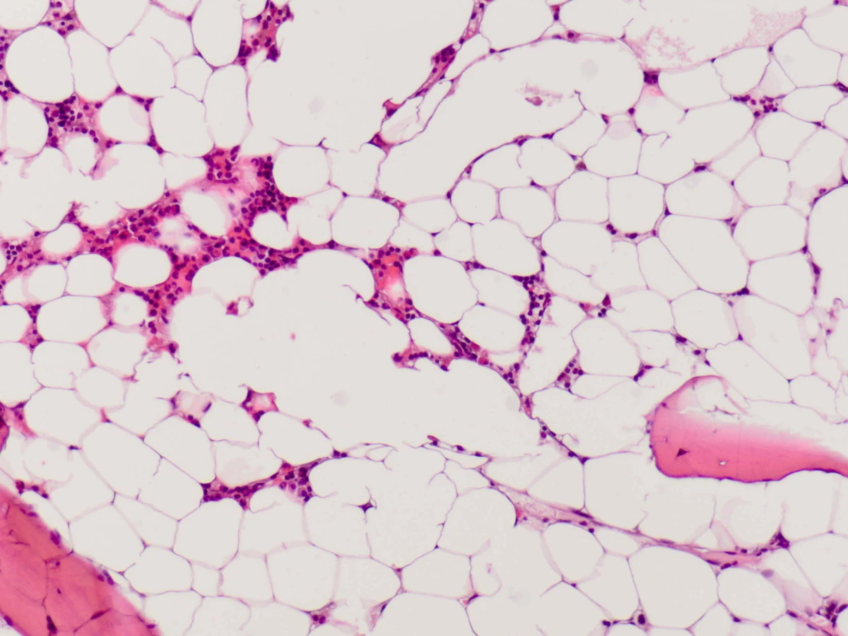 Bone marrow biopsy showing aplastic anemia
