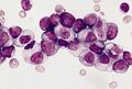 Polysomy