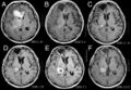 Anaplastic astrocytoma