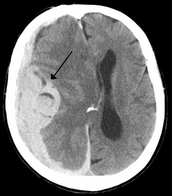Intracranial bleed with significant midline shift