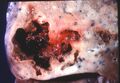 Lung abscess