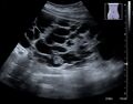 Advanced polycystic kidney disease with multiple cysts
