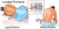 Illustration of lumbar puncture