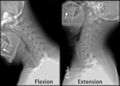 Condyloid fossa