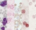 Micrograph of acute monocytic leukemia