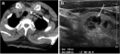 CT of thyroid colloid nodule with calcification
