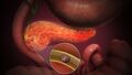3D Medical Animation of Acute Pancreatitis