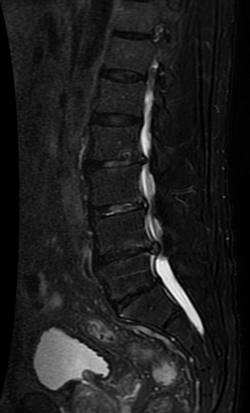 Lumbar spinal stenosis 3 9 Lumbar MRI showing a spinal stenosis in severe degree in L4-L5 and in moderate/severe degree in L2-L3 and L3-L4.