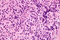 Primary mediastinal large B-cell lymphoma - very high magnification