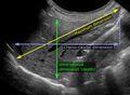 Liver measurements on ultrasonography