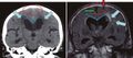 Cerebral atrophy