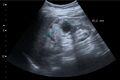 Renal cell carcinoma with both cystic and solid components