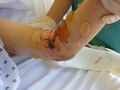 Acute Compartment Syndrome with blister formation