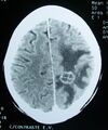 CT scan showing brain tumor